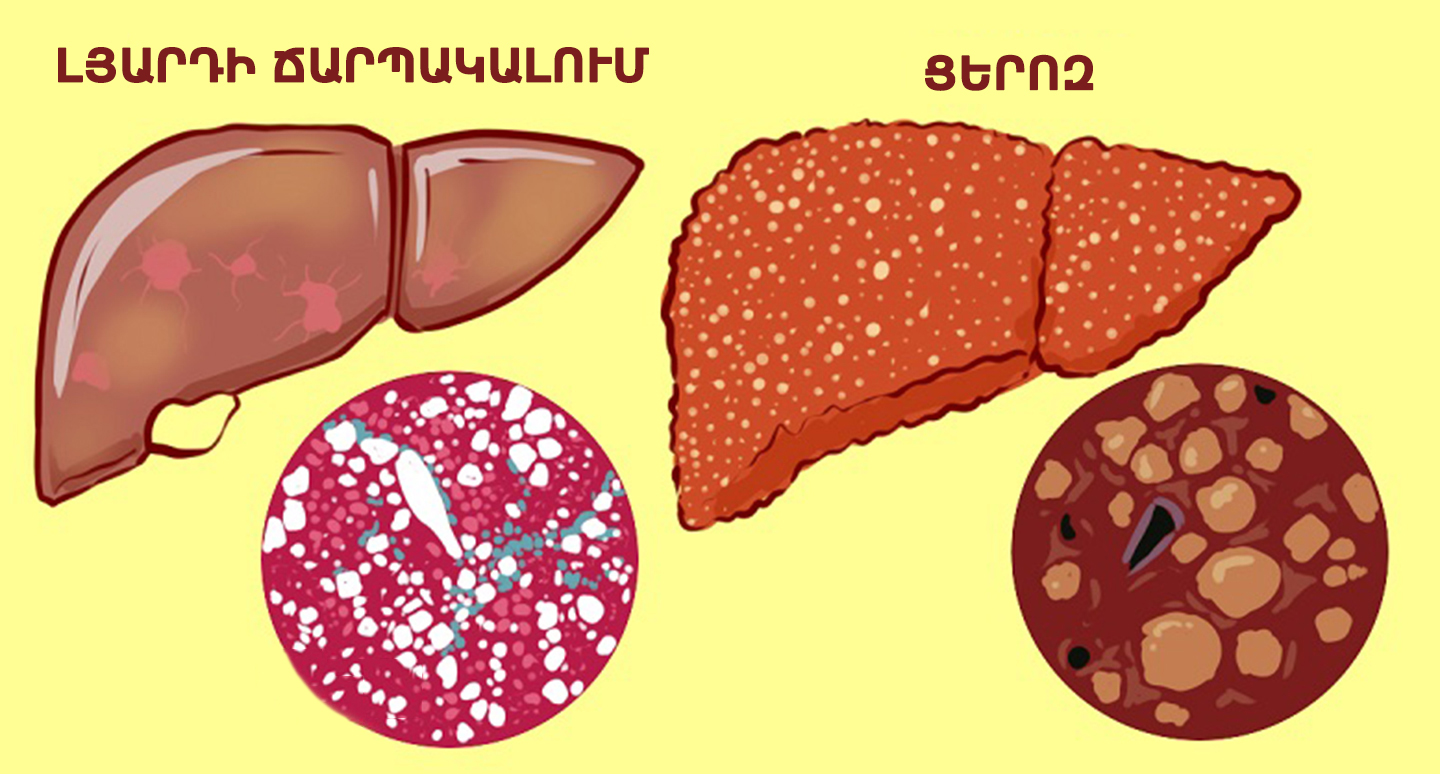 Жировая печень что кушать. Гепатоз ожирение печени. Печень рисунок. Гепатоз печени диета.